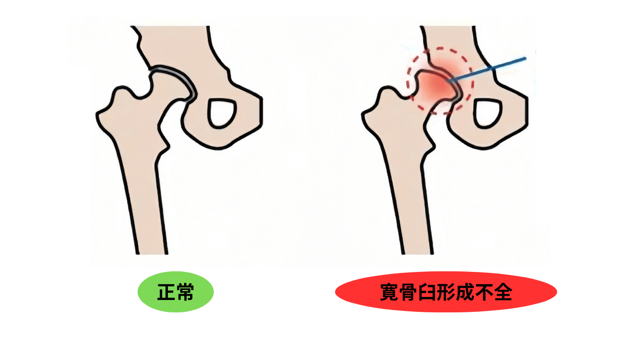 寛骨臼形成不全の図解